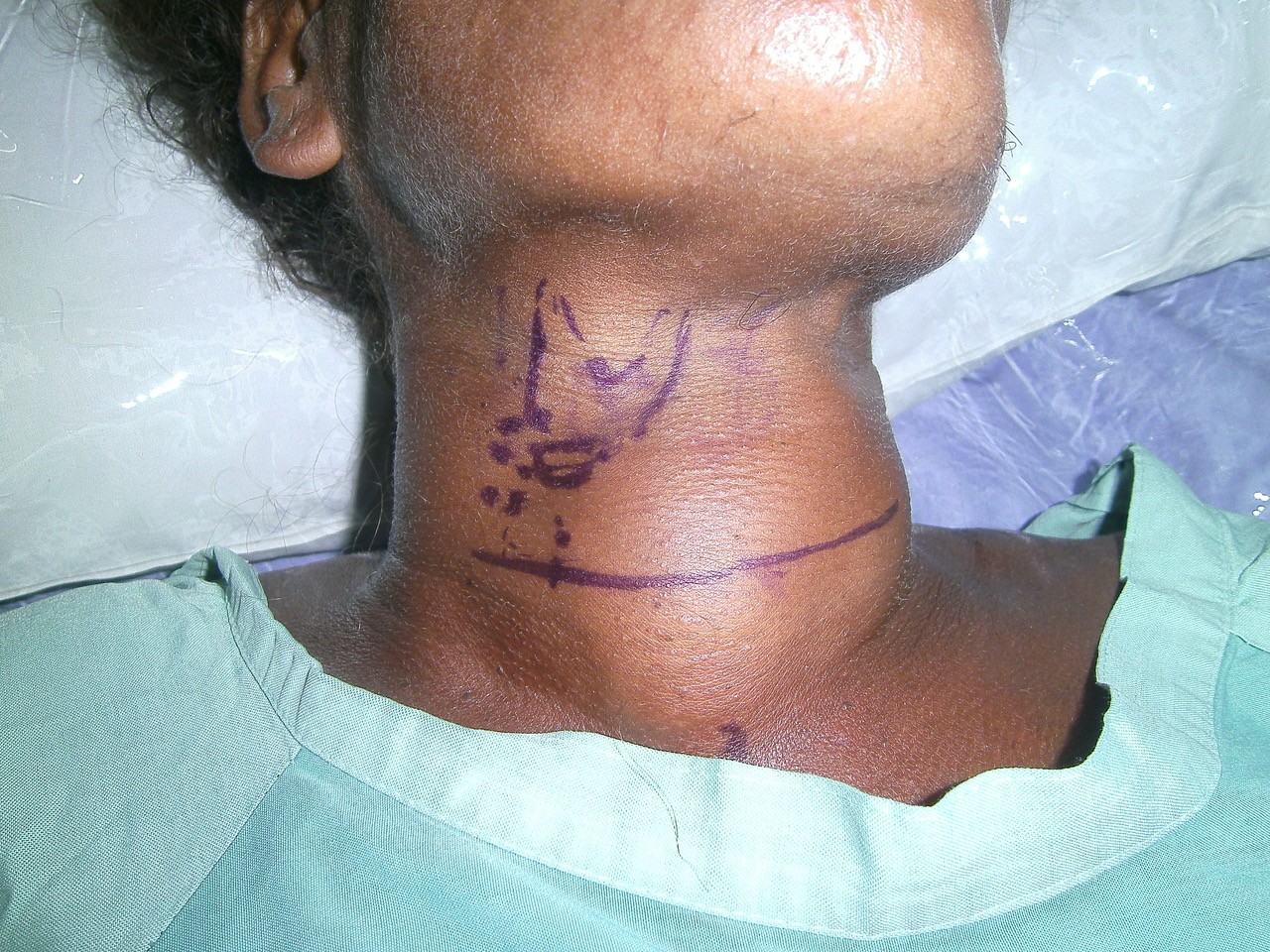 Benign multinodular goitre pushing airway – marked in purple – away from midline